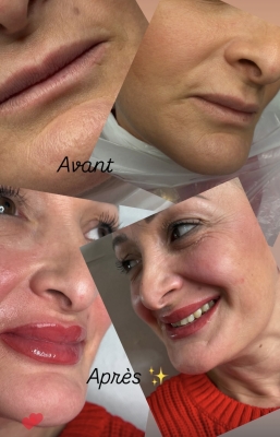 BOUCHE AVANT/APRÈS